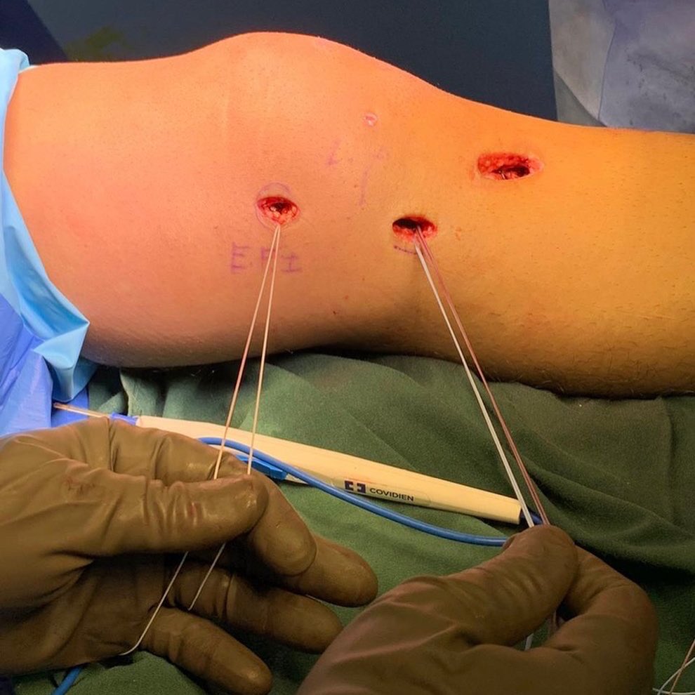 lpcsmd's tweet photo. Tratamiento de lesión multiligamentaria de rodilla en paciente de 22 años en quien se realiza reconstrucción del ligamento cruzado anterior + reparación ligamento colateral medial + augmentación con internal brace #aclandmclinjury #aclrecon #mclrepair #internalbrace #arthrex https://t.co/plj6GhhEbA
