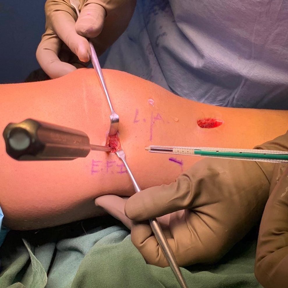 lpcsmd's tweet photo. Tratamiento de lesión multiligamentaria de rodilla en paciente de 22 años en quien se realiza reconstrucción del ligamento cruzado anterior + reparación ligamento colateral medial + augmentación con internal brace #aclandmclinjury #aclrecon #mclrepair #internalbrace #arthrex https://t.co/plj6GhhEbA