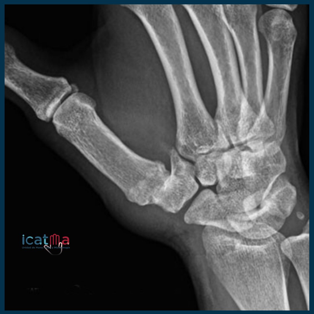 instituto_mano's tweet photo. #rizartrosis por #artroscopia Cuando indicamos este procedimiento obtenemos menor índice de #dolorpostoperatorio, menos #cicatrizquirúrgica, y reducimos el riesgo de lesionar los ligamentos-nervios de la articulación con recuperación más precoz de la sintomatología @quironsalud https://t.co/gzls97kPcA