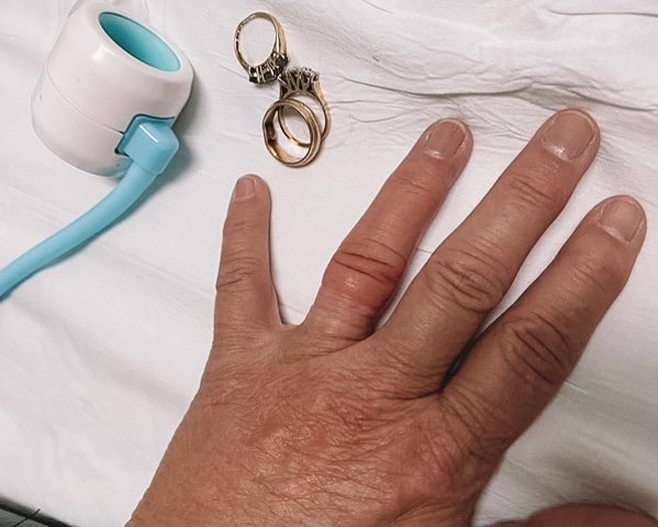 ER doctor, students invent device for common hospital complaint: rings  stuck on fingers