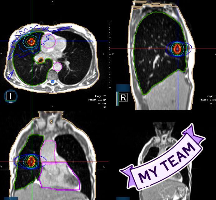 📣 Single fraction respiratory-gated lung SBRT delivered in overall 38 minutes using the MRIdian system!

#SoProud #MyTeam #MRgRT #SBRT #RadOnc #oligomets 
@viewray