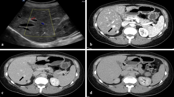 RadiolMed's tweet photo. Editor's Pick: ABDOMINAL RADIOLOGY
Hepatic hemangiomas: the various imaging avatars and its mimickers
https://t.co/qOJPPvDQGG
#radiology @PhilipRishi @UAlberta @CARadiologist https://t.co/peVLOQbgi8