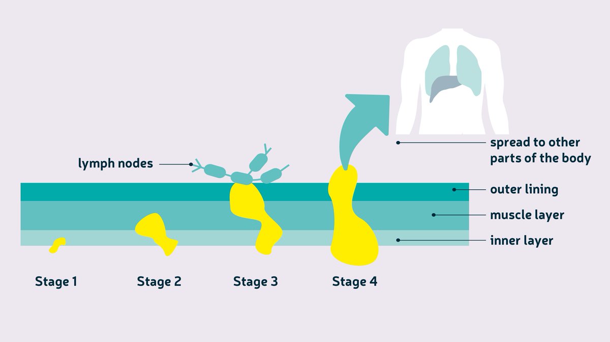 bowelcanceruk's tweet image. Advanced #bowelcancer is when cancer has spread from the bowel to other organs in the body. A diagnosis can be daunting, we’ve pulled together all our information and support for people with advanced bowel cancer on our website. Find it here: bowelcanceruk.org.uk/about-bowel-ca…