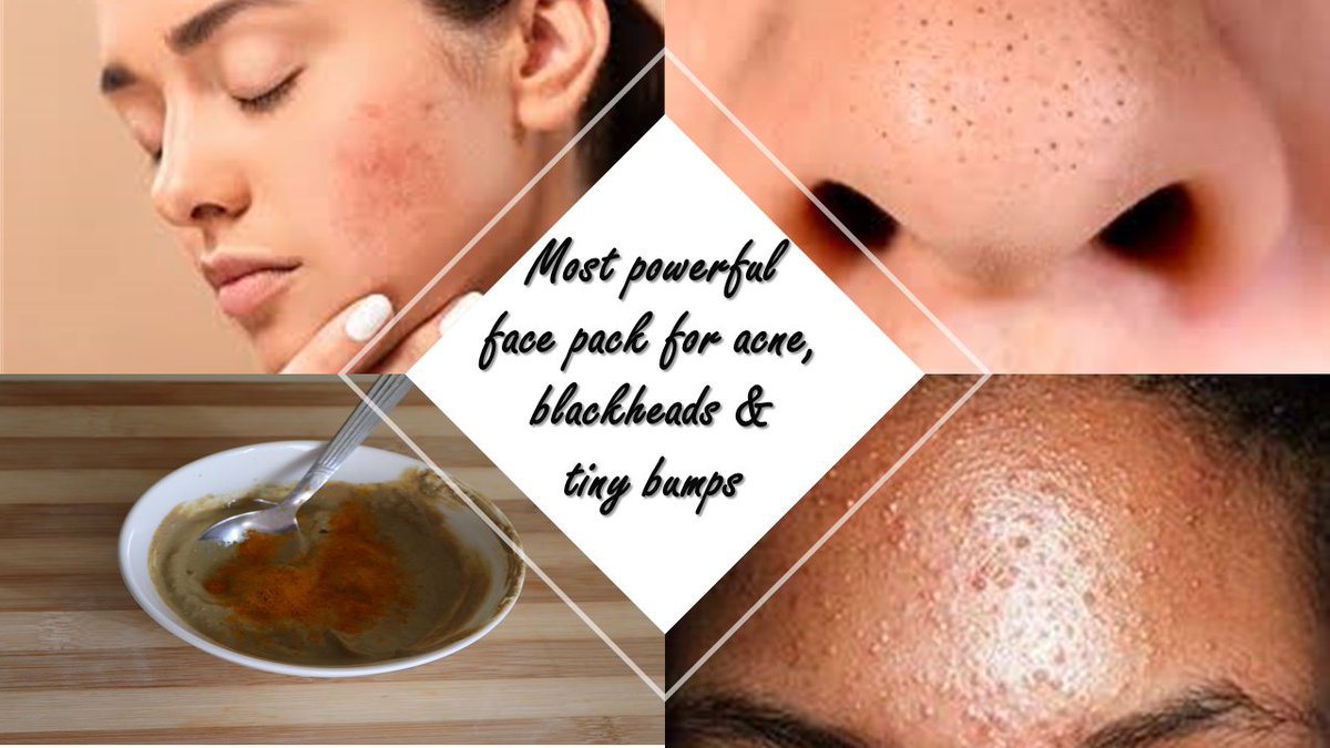 homelytips365's tweet photo. Most Powerful Face Mask to clear acne, blackheads and tiny bumps| Get  s... https://t.co/wNo45xgqKp via @YouTube https://t.co/5tljT1hclu