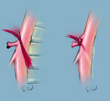 ctisus's tweet photo. Median arcuate ligament syndrome https://t.co/p8so44PlLJ