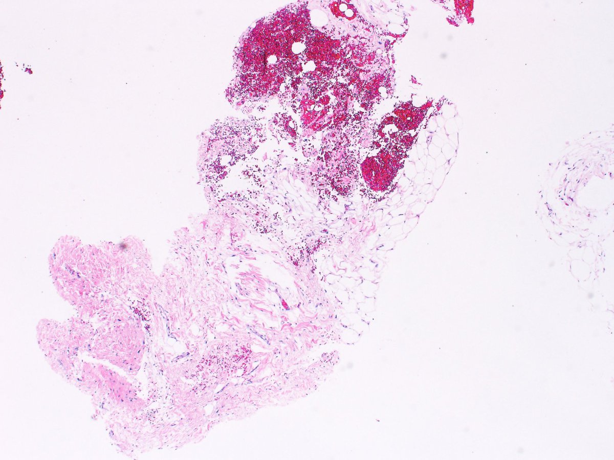 nephrosharma's tweet photo. Another biopsy showing fibroconnective tissue and blood. Identifying adequacy with a smartphone is a simple and helpful practice at the time of performing kidney biopsy. https://t.co/TkPupZfNwr