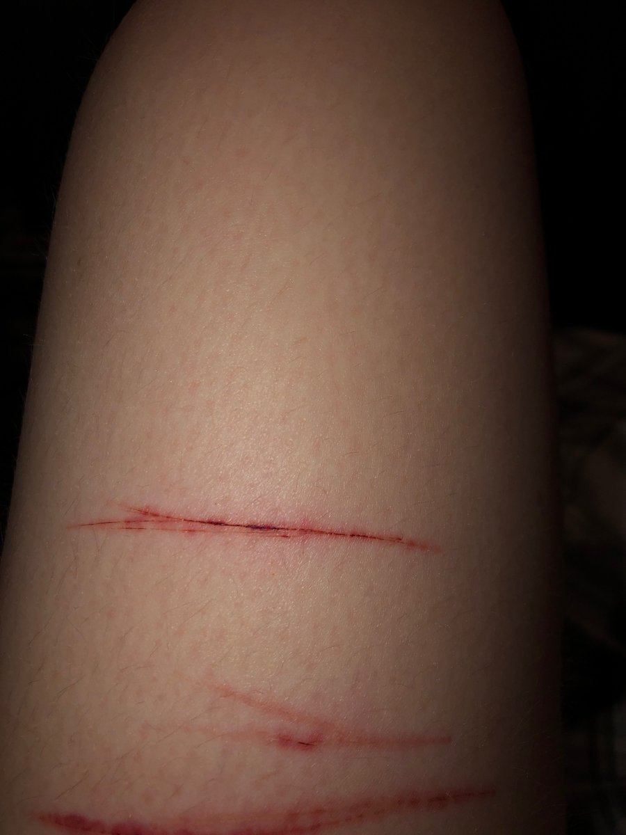 Deep Cuts On Leg