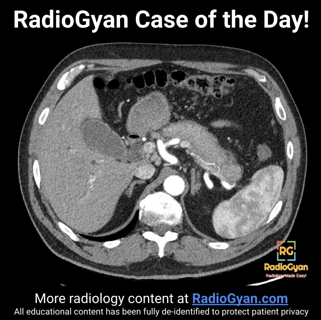 RadioGyan's tweet photo. #RGCOD #65
Hey #radres and #radtwitter
What is your diagnosis for this #radiology case?
Hx: Acute onset jaundice with abdominal pain.
*No answers or spoilers*. Appropriate GIFs only!
#radres #FOAMed #FOAMrad #bodyrad #MedEd #medtwitter #SABI2020 https://t.co/DyzcwxxdRB