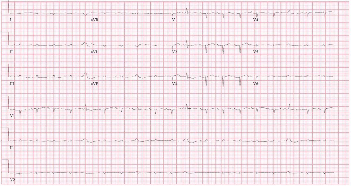 Case: 70 yo woman w/paroxysmal AFib, HTN, T2DM hasn’t seen MD in a few years admitted w/acute decompensated HF. ECG with low volts. Echo: LVEF 32%, LV wall thickness, & severely TDI velocities (s’, e’, and a’ < 5 cm/s at the septum, nearly this low at lateral mitral annulus).
