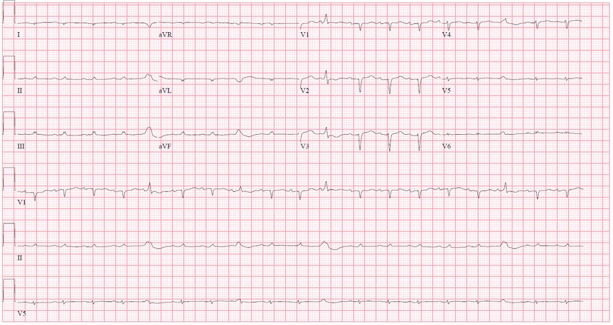 Case: 70 yo woman w/paroxysmal AFib, HTN, T2DM hasn’t seen MD in a few years admitted w/acute decompensated HF. ECG with low volts. Echo: LVEF 32%, LV wall thickness, & severely TDI velocities (s’, e’, and a’ < 5 cm/s at the septum, nearly this low at lateral mitral annulus).