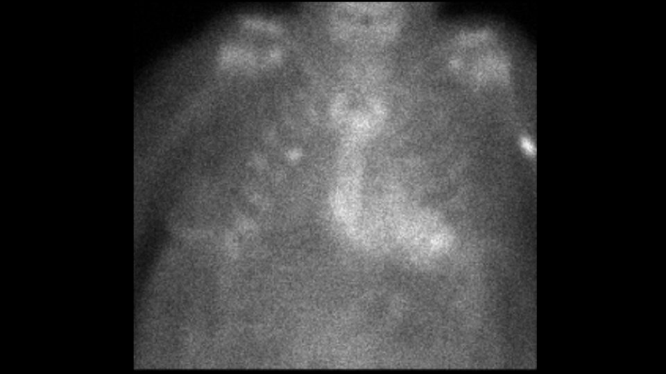 AL labs show no evidence of a plasma cell dyscrasia. PYP scan shows heart-to-contralateral lung ratio = 1.5, qualitative grade 3 uptake. Here is the planar image (myocardial uptake corroborated on SPECT):