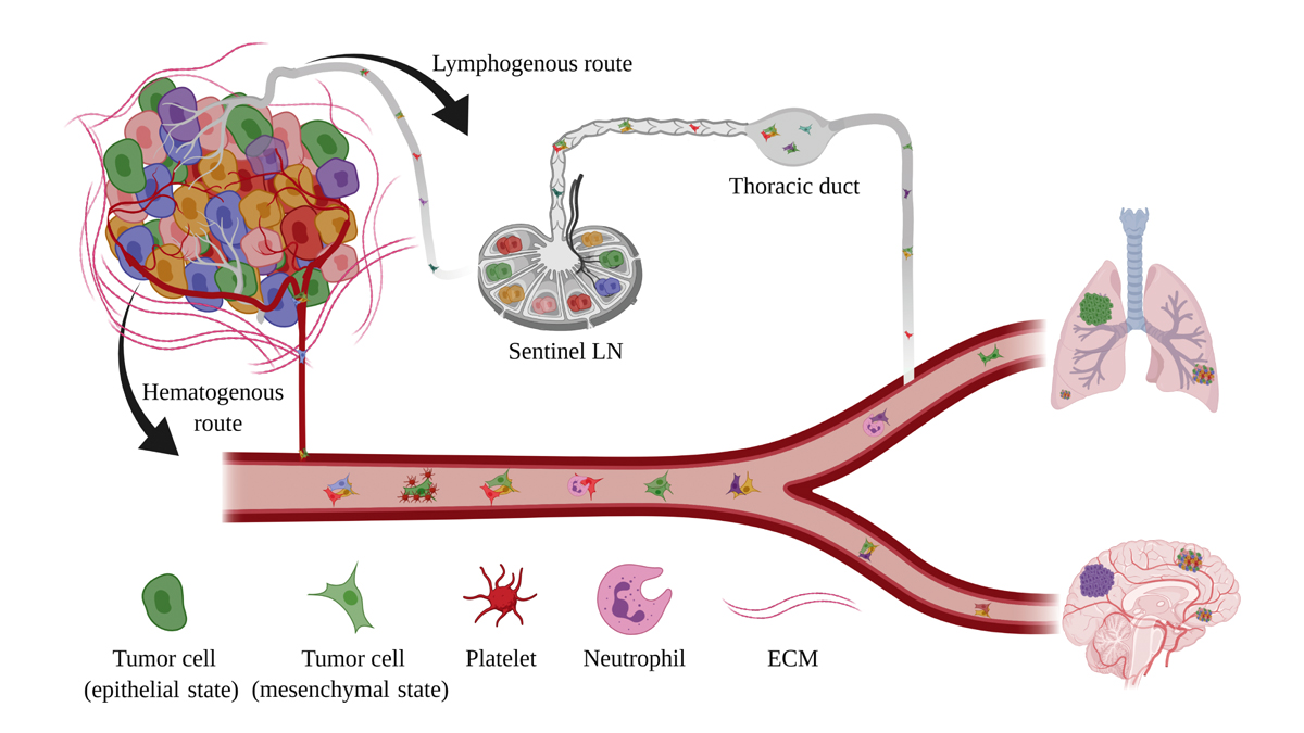 RockUPress's tweet photo. In this #JEMCancerFocus review in @JExpMed, Abdul Pari, @mahak906 and @HellmutAugustin from @DKFZ review contemporary #metastasis research and provide a framework for advancing bench-to-bedside translation of fundamental preclinical discoveries. https://t.co/cmdGSw5xbq https://t.co/XhXsnQPysU