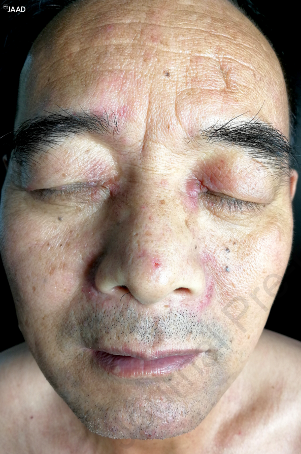 JAADjournals's tweet photo. Seborrheic dermatitis like presentation of dermatomyositis – be on the lookout! Also, if you find one of these patients, make sure to workup for interstitial lung disease- a series of 11 patients, link below: https://t.co/AlPUDxHxG6 https://t.co/MZat7LWuzG