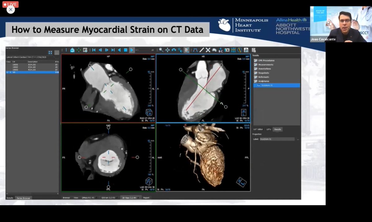 DavidHautemann's tweet photo. Enjoying the State of the Art Cardiovascular CT meeting! Great presentation by @JoaoLCavalcante showing how strain can be done on CT obtaining interesting results! @BSCImaging  @Heart_SCCT @MedisImaging  @YesCCT https://t.co/SwsMVAe6xd
