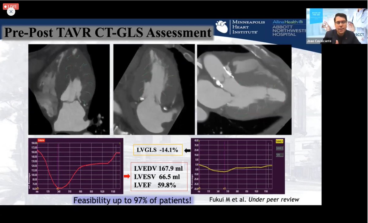 DavidHautemann's tweet photo. Enjoying the State of the Art Cardiovascular CT meeting! Great presentation by @JoaoLCavalcante showing how strain can be done on CT obtaining interesting results! @BSCImaging  @Heart_SCCT @MedisImaging  @YesCCT https://t.co/SwsMVAe6xd