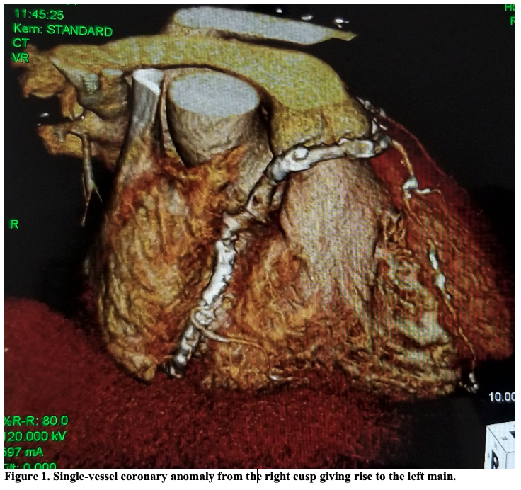 Online First at CLD! 
Anomalous Left Coronary Artery From the Right Coronary Cusp
Pradnya Brijmohan Bhattad, MD; Vinay Jain, MD; Mohit Bhasin, MD
cathlabdigest.com/anomalous-left…  <a href="/InvasiveCardiol/">Journal of Invasive Cardiology</a> #cardiotwitter #cardiology #medtwitter