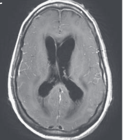  #idboardreview 30 F polyarthritis, migraine, multiple sclerosis on rituximab, prednisone, recent sinusitis,has school going kids presents in winter w/F, HA, photophobia, meningismus progresses to encephalitis. No improvement w/ acyclovir & antibiotics. Diagnosis?  #medEd  #idmedEd