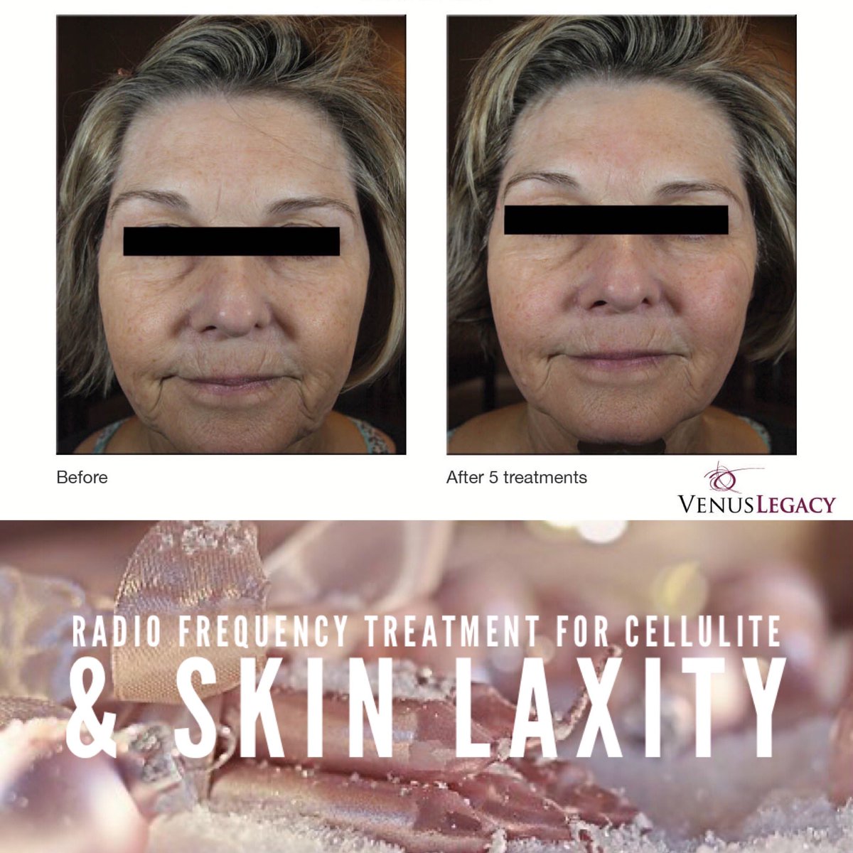 BT_LaserRemoval's tweet photo. 👑BK 👒BT 💝A&amp;A
#laserhairremoval #hairremoval #bodycontouring #3dmicroblading #beauty #microbladingwithiman #microblading #eyebrowtattoo #microneedling #cellulite #photorejuvenation #skintightening #acnes #hydrafacial #IPL #skinresurfacing #teethwhitening #michigan https://t.co/TUZELZ0szt