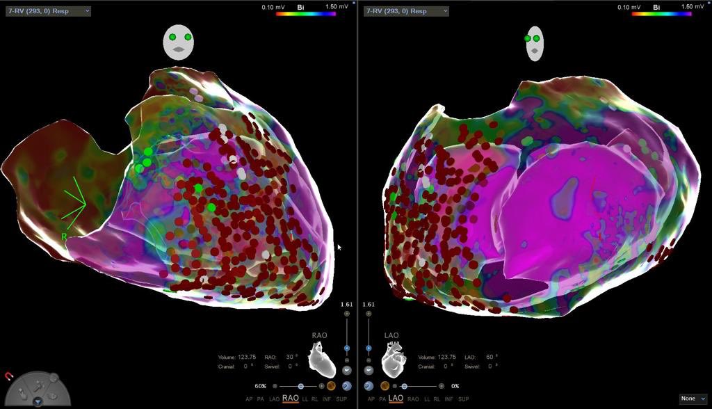 EPI week @HDZ NRW! Last case of the week VT Storm in DCM with epi ARVC pattern...now Time for 🎄<a href="/Phiso_de/">Philipp Sommer</a> @BergauLeonard <a href="/EPDeneke/">Thomas Deneke</a> @MaikeNunning <a href="/bisbal_EP/">Felipe Bisbal</a> <a href="/ChristianHeeger/">Christian-H. Heeger</a>