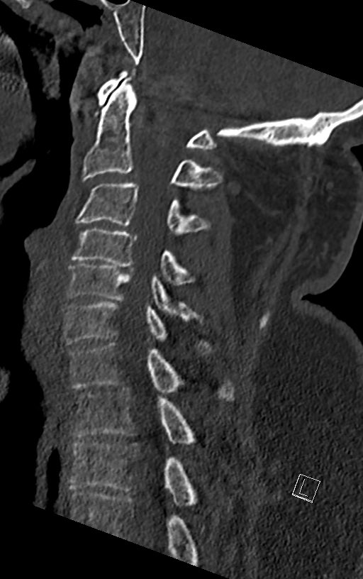 odontoid fracture type II:epic controversial discussions, how to treat them in the elderly, when  #comorbidity index is high.this is a  #odontoid process/dens axis in a patient with radiculomyelopathy.osteoarthritis of the atlantodental joint is present, tooa case thread