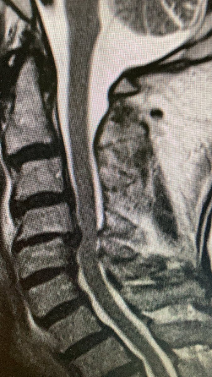 odontoid fracture type II:epic controversial discussions, how to treat them in the elderly, when  #comorbidity index is high.this is a  #odontoid process/dens axis in a patient with radiculomyelopathy.osteoarthritis of the atlantodental joint is present, tooa case thread