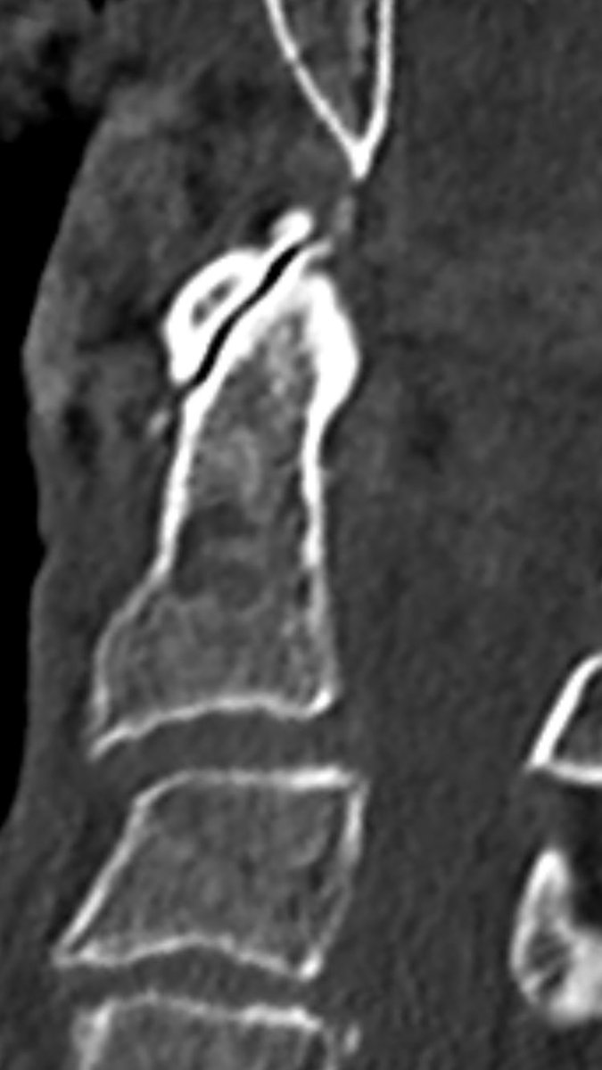 odontoid fracture type II:epic controversial discussions, how to treat them in the elderly, when  #comorbidity index is high.this is a  #odontoid process/dens axis in a patient with radiculomyelopathy.osteoarthritis of the atlantodental joint is present, tooa case thread