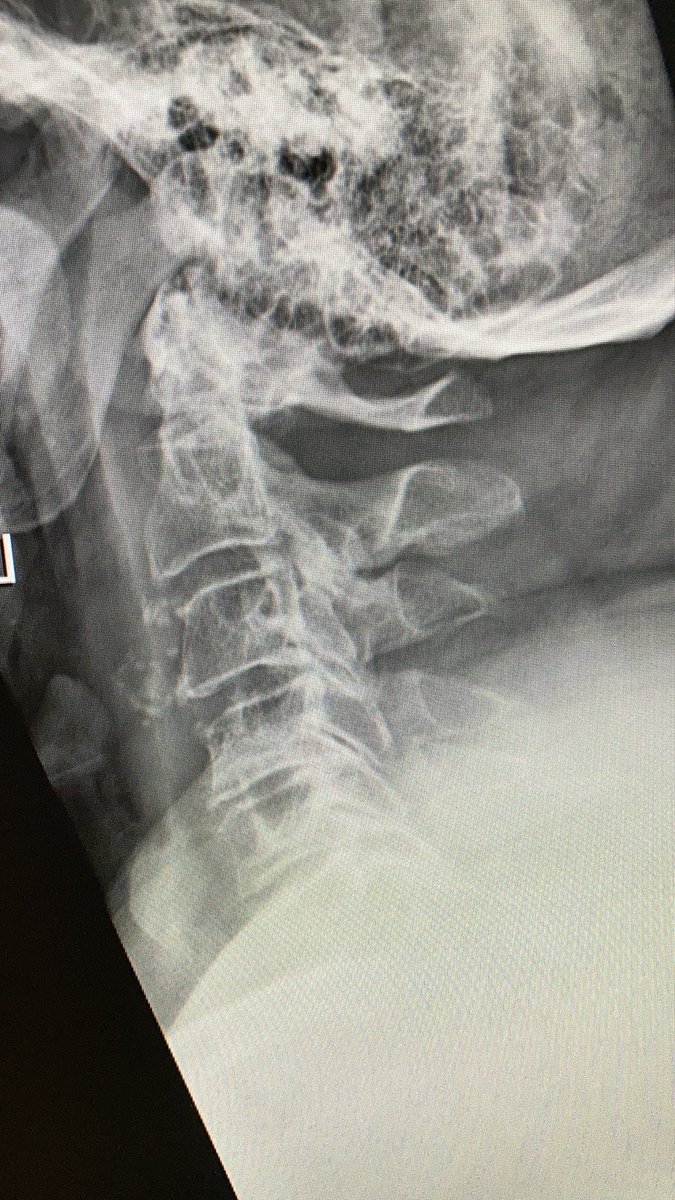 odontoid fracture type II:epic controversial discussions, how to treat them in the elderly, when  #comorbidity index is high.this is a  #odontoid process/dens axis in a patient with radiculomyelopathy.osteoarthritis of the atlantodental joint is present, tooa case thread
