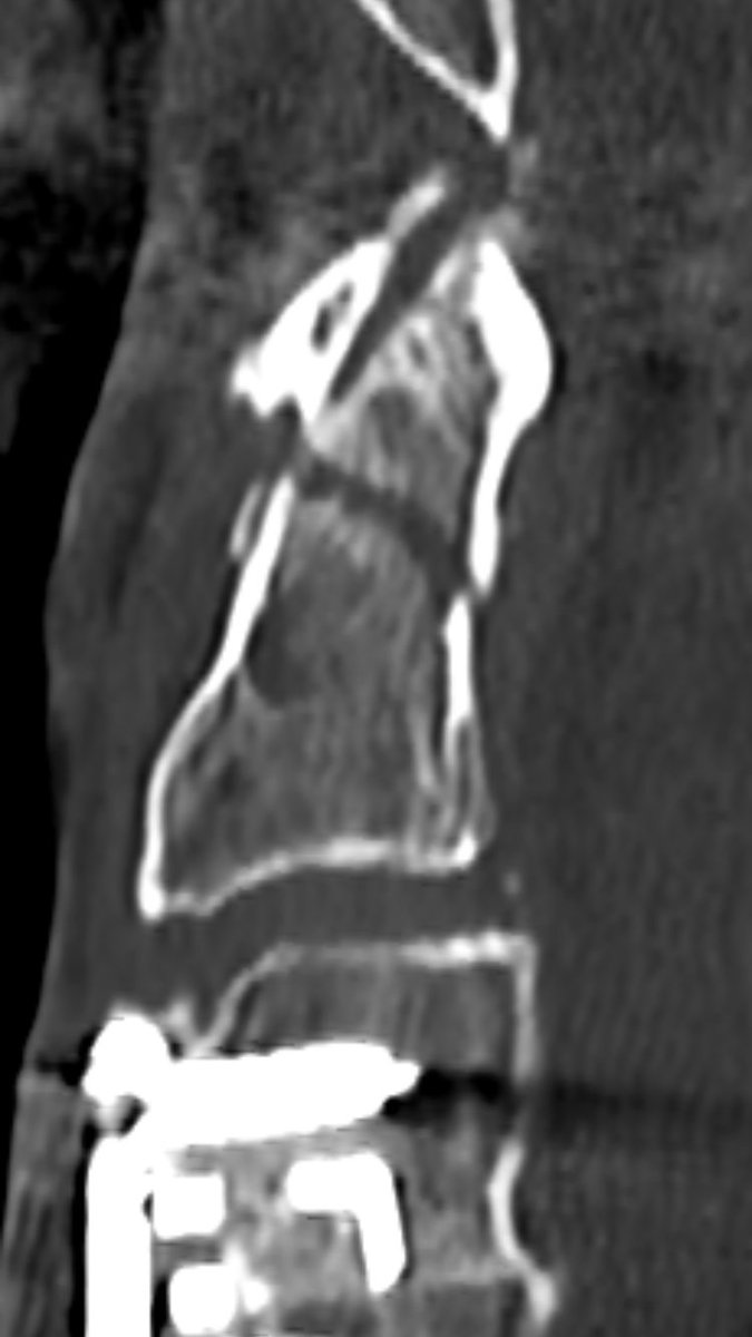 follow up after 8 weeks (l) and 6 month (r) show non-union, as expected. It’s a pseudarthosis.but he was painfree right after 2 month.You can nicely see signs of remodelling, but the fracture line still remains.
