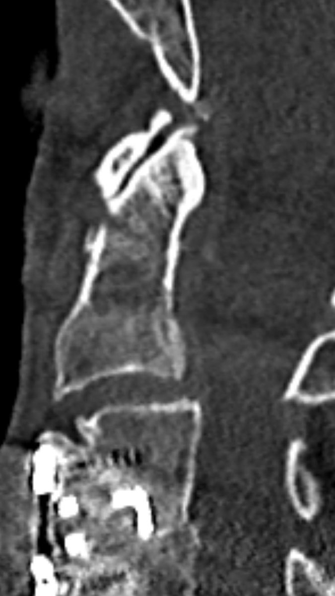 4 years later (after ACDF), he fell and sustained odontoid fracture type II according to Anderson/d’Alonzo. you see the fracture line - and no, it’s not “incomplete”, it’s for sure complete, just the positioning in the CTscan. As pain was no problem, we’ve put him in a collar
