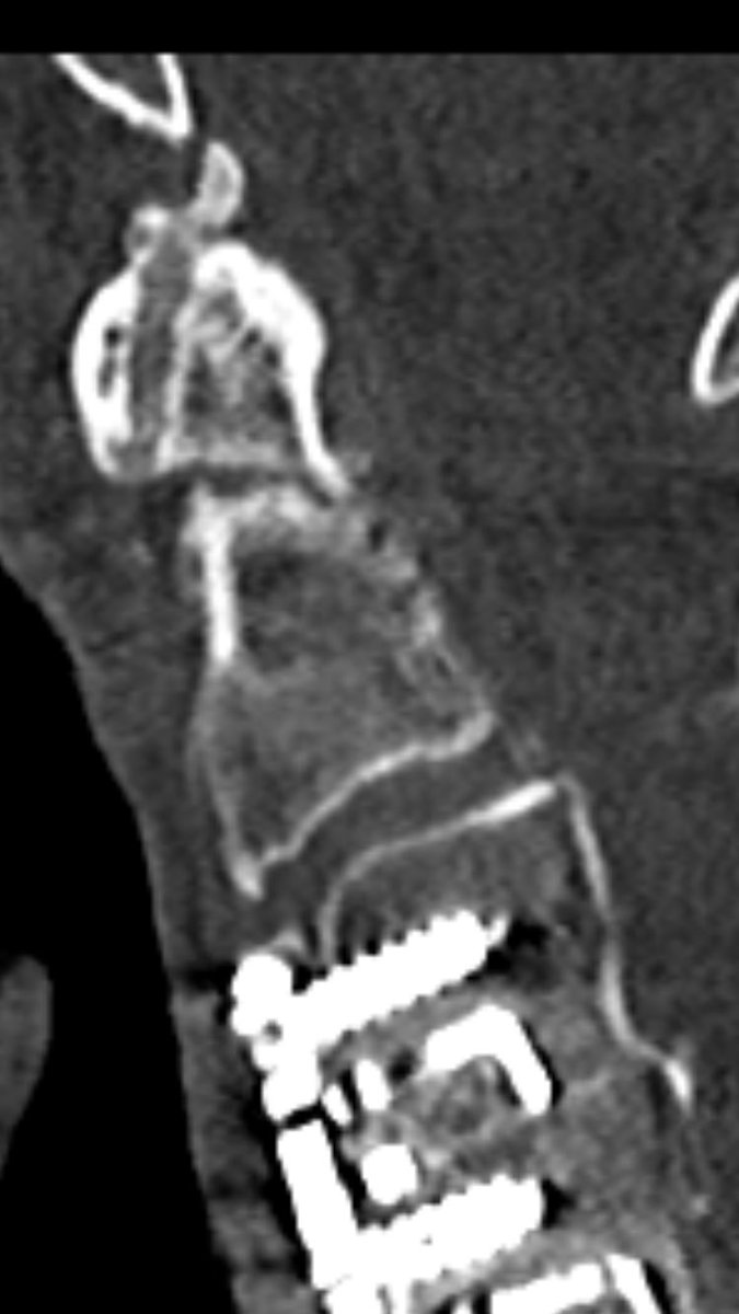 after 16 month, remodelling is still ongoing: surprisingly the atlantodental joint is now ankylosed and the fracture line is narrowed, but still not fused.he had no pain, and a subjective sufficient function for daily activities. he was fine!(CT was performed for other reason)