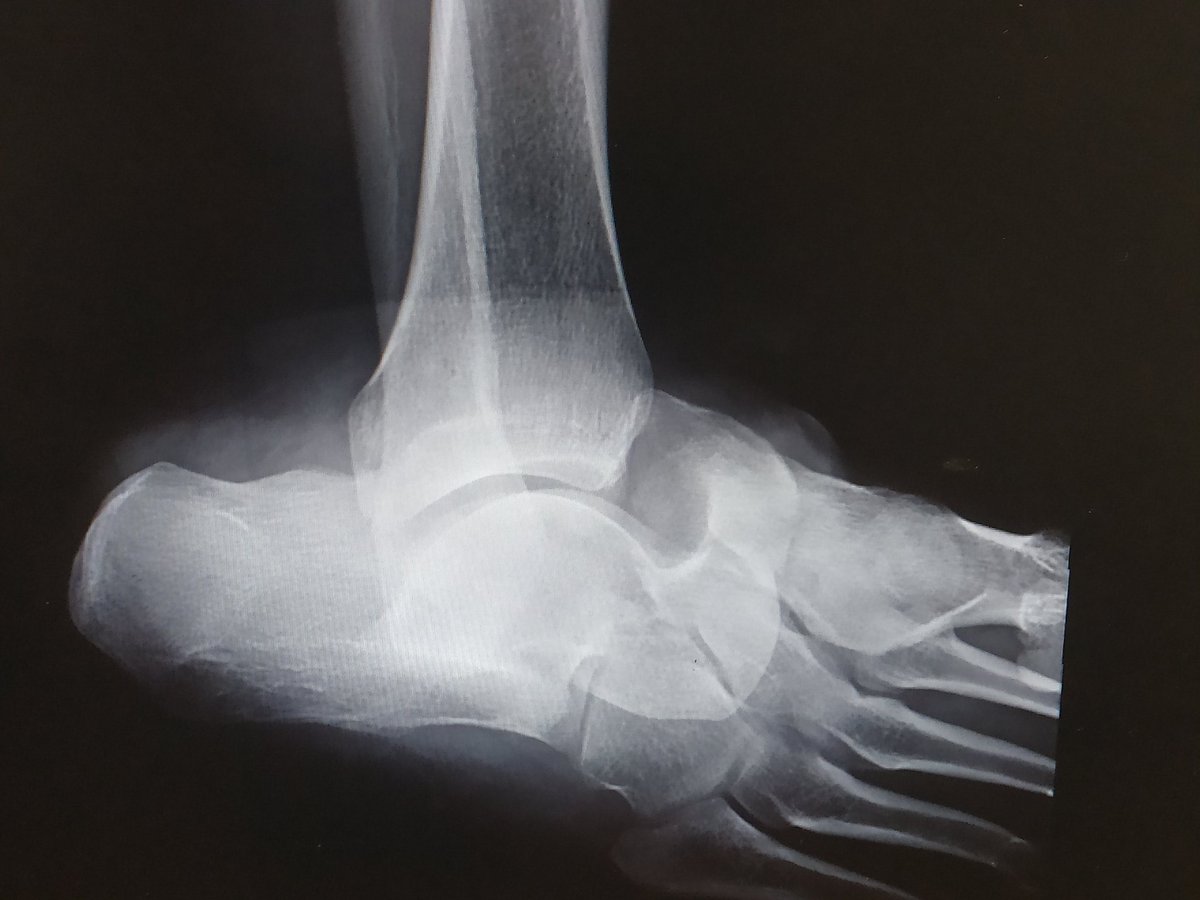TopLondonOrtho's tweet photo. While this poor soul slipped on a wet floor.... 😬 #talonavicular #subtalar #dislocation #orthotwitter @NaanDerthaal https://t.co/Fjt3Xh7cU8