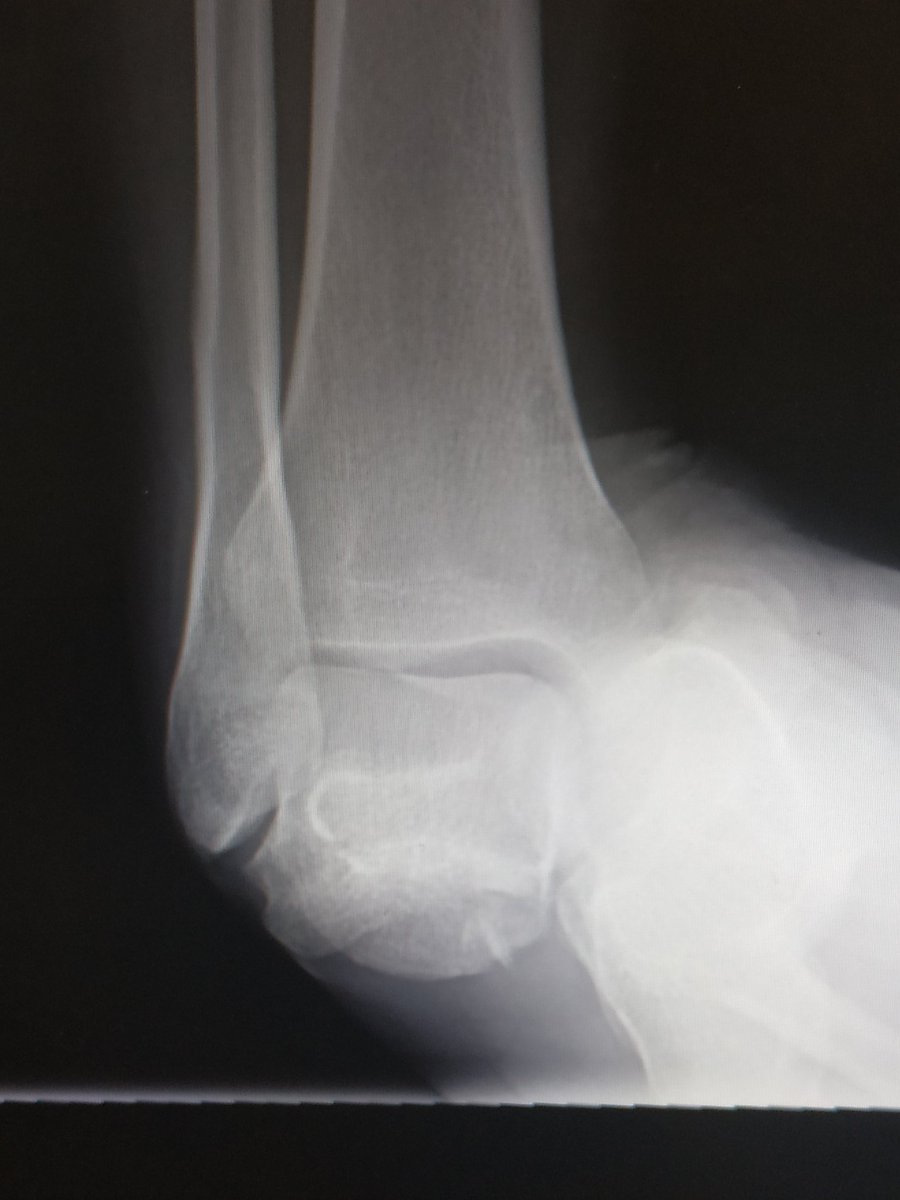 TopLondonOrtho's tweet photo. While this poor soul slipped on a wet floor.... 😬 #talonavicular #subtalar #dislocation #orthotwitter @NaanDerthaal https://t.co/Fjt3Xh7cU8