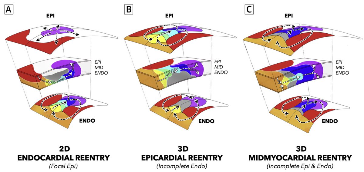 Roderick Tung (@drrodericktung) on Twitter photo <a href="/EPDeneke/">Thomas Deneke</a> Single PVC reset or entrain to confirm reentry. Likely reentrant pattern on another layer. <a href="/EPDeneke/">Thomas Deneke</a> Single PVC reset or entrain to confirm reentry. Likely reentrant pattern on another layer.