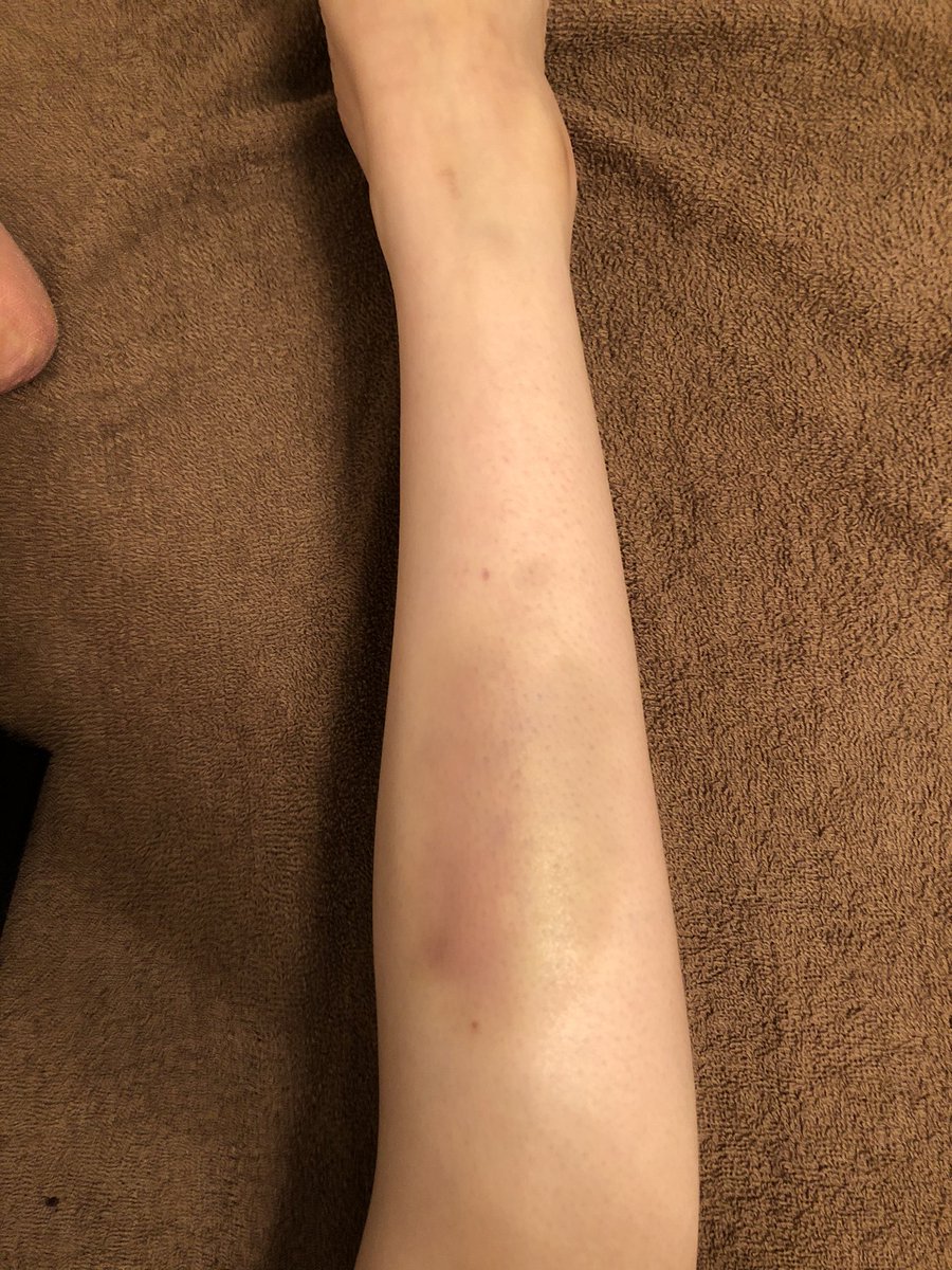 キックボクシングはじめようかと思っていたのですが、体験でこうなったので諦めます。スネで全力で振り抜くバカおる…？