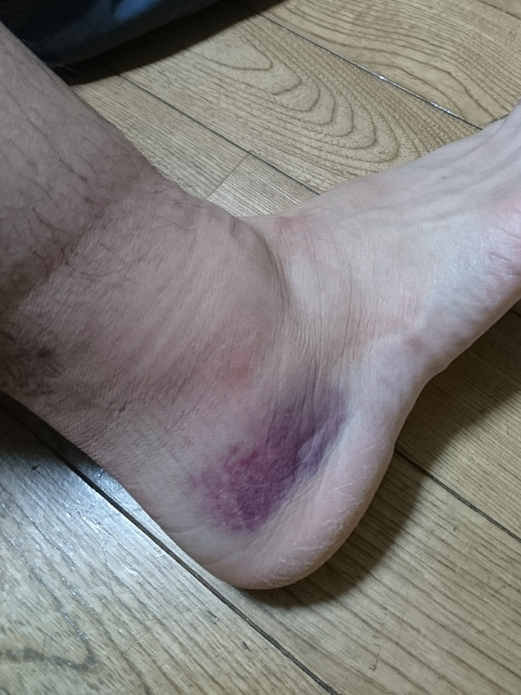 ドラゴン2 Tori 軽い捻挫ですね 一応病院行った方がいいかなぁ 俺は捻挫でゴルフボール以上テニスボール以下くらい腫れて完全に治るまで3ヶ月から半年かかりましたよ 笑 Twitter