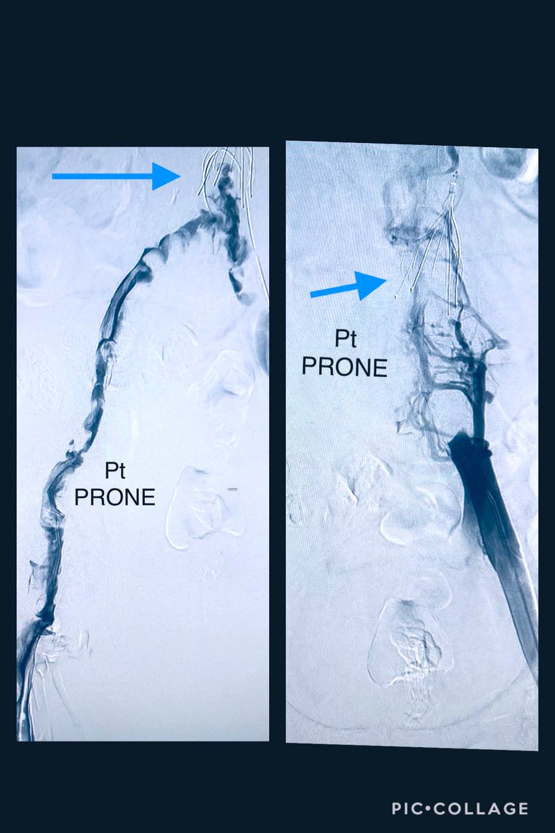 t_intheleadcoat's tweet photo. Friday #GTFO
2 wks post CABG, extensive #filter related iliocaval thrombosis.
@InariMedical #clottriever #flowtriever for #singlesessionthrombectomy
#NoTPA #NoICU
Do you start pt prone & then supine or vice versa ??
Thx to Dr.Park for help. @keithppereira @farkomd #IRad https://t.co/6efD7I5wAq