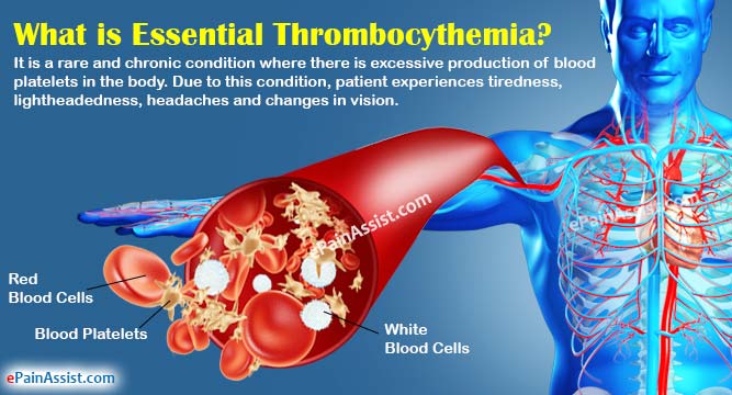 Oxidative stress in essential thrombocythemia patients on risk-adapted therapy #DHPSP #INPST #Myeloproliferative #Neoplasms #MPN #EssentialThrombocythemia #Hematology #Blood #Hydroxyurea #OxidativeStress #Anagrelide #ReactiveOxygenSpecies #Aspirin umbalk.org/the-evaluation…