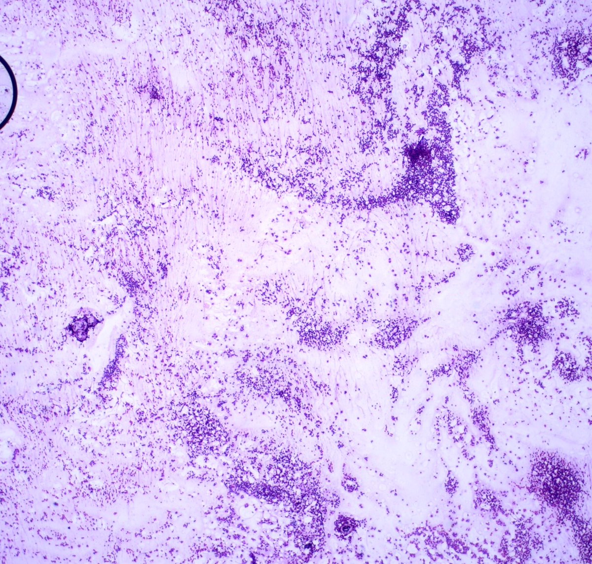  #Breastpath  #cytopath52 Year old female; multifocal right sided breast cancer undergoing mastectomy with SLN bx.Intraoperative sentinel node touch prep shown. If cancer —> axillary dissection.3 pages of pics, and a poll.1/4
