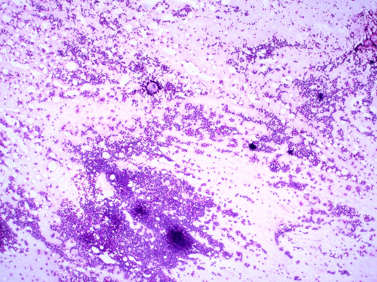  #Breastpath  #cytopath52 Year old female; multifocal right sided breast cancer undergoing mastectomy with SLN bx.Intraoperative sentinel node touch prep shown. If cancer —> axillary dissection.3 pages of pics, and a poll.1/4
