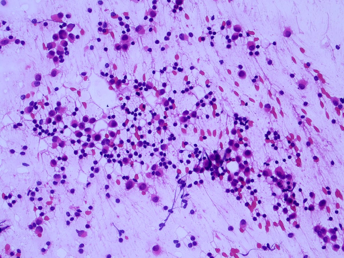 2/4Tagging some breast/cyto folks: @Jbird42077503  @RoncinMD  @KaravelicMD  @ADamronMD  @GuzmanArocho  @MComptonMD  @Sara_Jiang  @MauroSaieg  @ZMaleki_cyto  @mdlozanoe  @ac_pathgal  @VandaTorousMD  @sza_jhcyto  @VarshaManuchaMD  @LizaMQuintana  @ADamronMD  @oreoimc  @doc_kartik  @cjvand