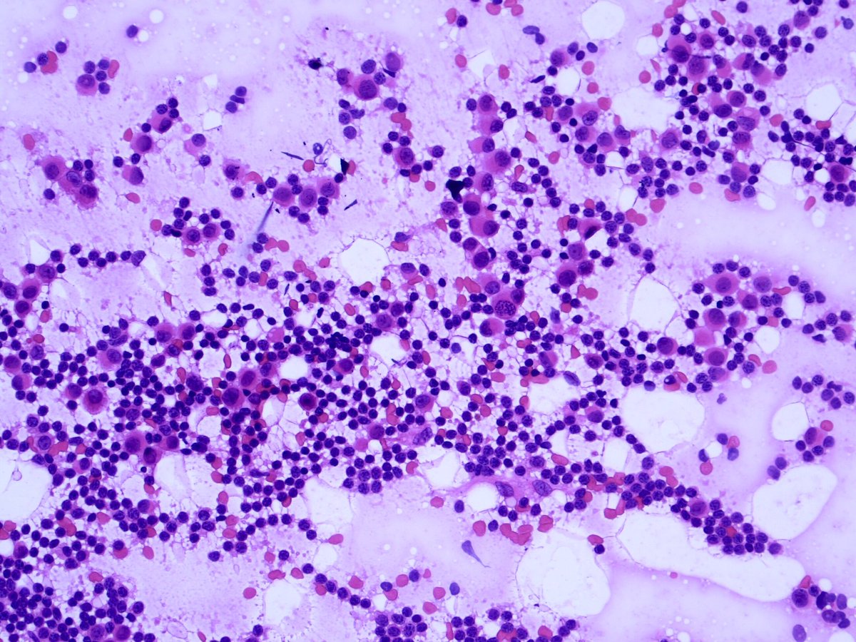 2/4Tagging some breast/cyto folks: @Jbird42077503  @RoncinMD  @KaravelicMD  @ADamronMD  @GuzmanArocho  @MComptonMD  @Sara_Jiang  @MauroSaieg  @ZMaleki_cyto  @mdlozanoe  @ac_pathgal  @VandaTorousMD  @sza_jhcyto  @VarshaManuchaMD  @LizaMQuintana  @ADamronMD  @oreoimc  @doc_kartik  @cjvand