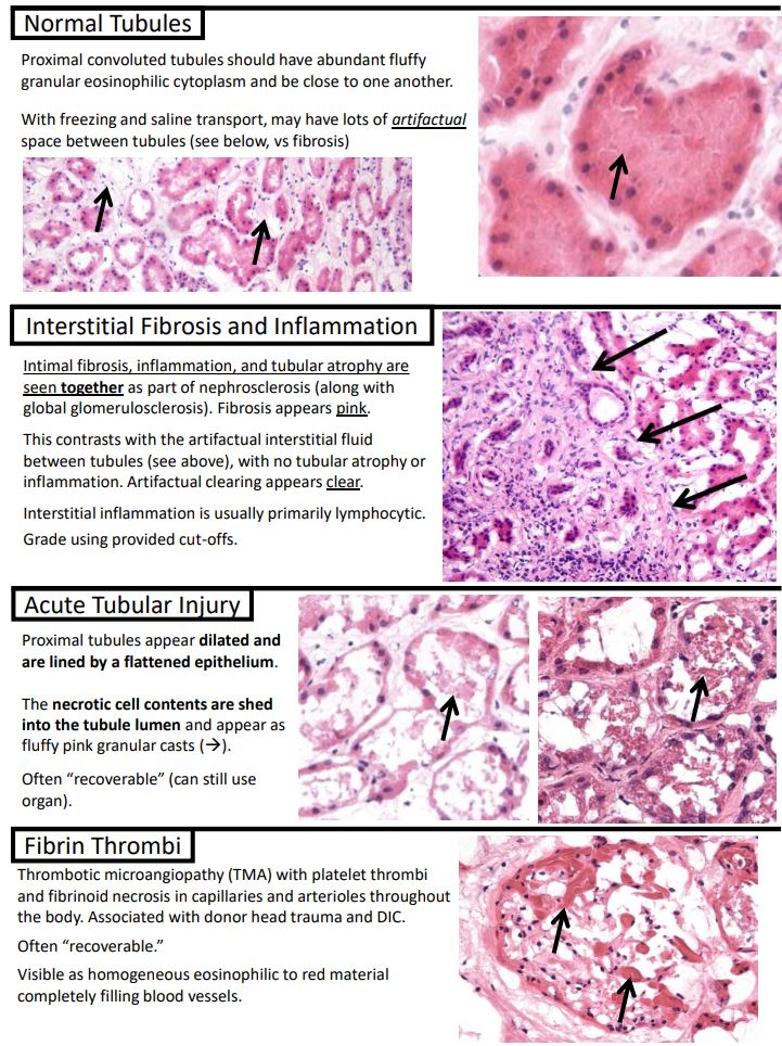 I made some handy "Kurt's Notes" (kurtsnotes.net) for those late night donor organ frozen sections😴📟🤔

Full notes available here: schaberg.faculty.ucdavis.edu/wp-content/upl…