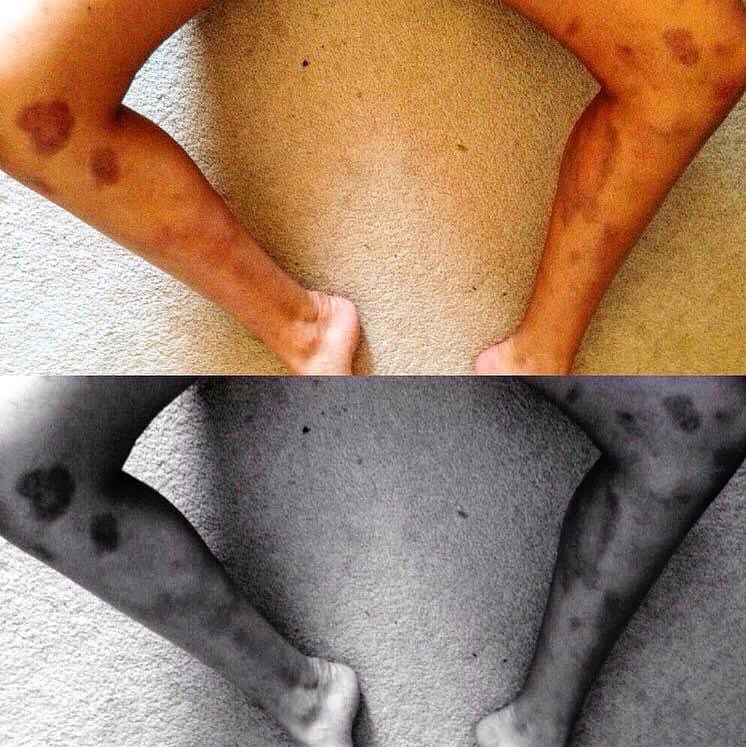 ronniedohertyy's tweet photo. “I often say rugby’s like Who else misses rugby? I miss having battle wounds on my legs every day and having people go “WHAT HAPPENED TO YOU?” 😮🤪
SATURDAY’S A RUGBY DAY!!! 🏉🙏🏻🔥
#Fullback #OBBRFC #Rugger #CanadianRugger #GirlsWhoPlayRugby #BattleWounds https://t.co/Q8DMQ4YAfX