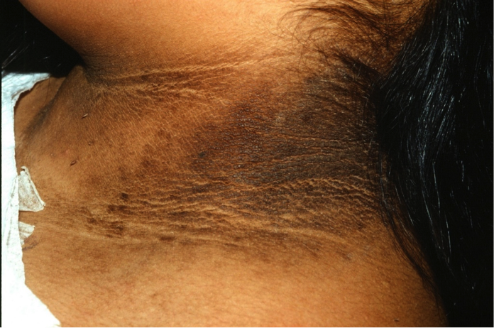 แบบนี้ Acanthosis nigricans เกิดจากฮอร์โมนผิดปกติ เช่น เป็นเบาหวาน ไม่ใช่ขี้ไคล เขาไม่ได้สกปรก