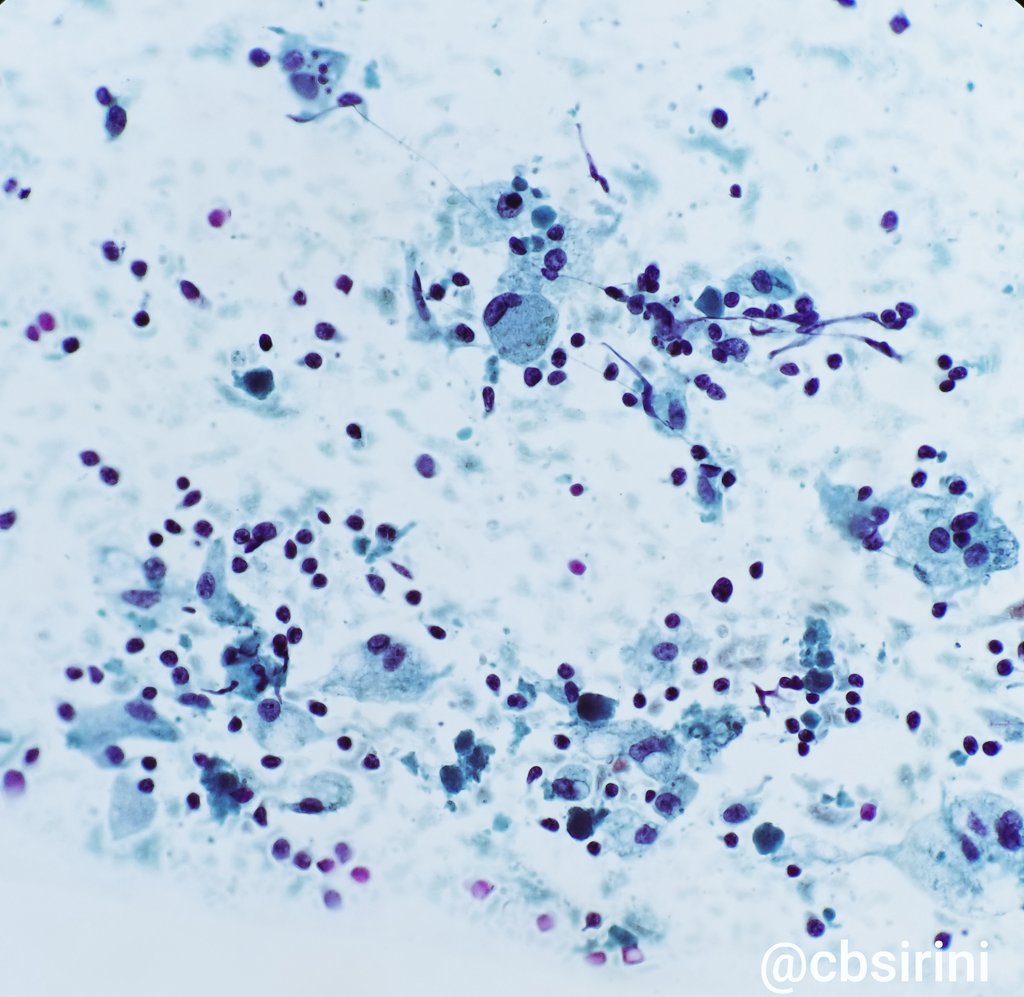 cbsirini's tweet photo. Seminoma: 
-Large dispersed cells 
-Voluminous cytoplasm with peripherally located vacuoles of glycogen (blister like cells)
-Macronucleoli
-Background of lymphocytes
-Granulomatous inflammation
@roula_katerji @catherinejroe @dannyjlubinpath @vaipath @ac_pathgal @DrGeeONE https://t.co/HUigSqGpFe