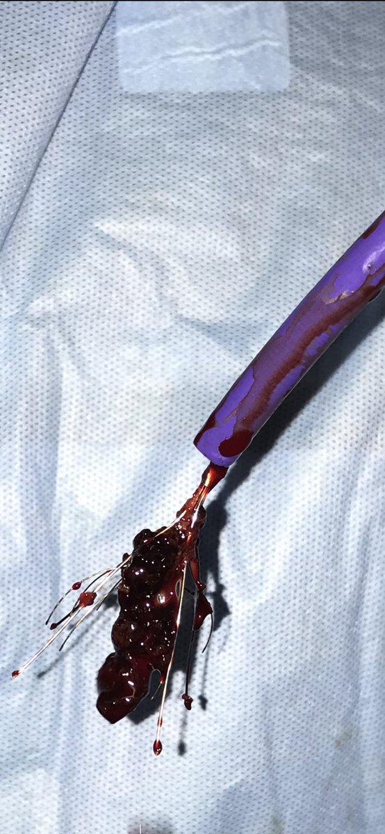 Charles Kim MD (@charlesykimmd) on Twitter photo During IVC thrombecomy, IVC filter >50% full of clot despite attempts to clear it. Retrieval via Triever24 w/ suction allowed en block removal of filter+clot. V. large sheath while exerting suction might work too? Anyone tried? <a href="/LessneVIR/">Mark Lessne, MD</a> <a href="/kush_r_desai/">Kush Desai</a> <a href="/rkryu/">RK RYU</a> <a href="/RonaldWinokurMD/">Ronald Winokur, MD, FSIR, FAVLS, RPVI</a> During IVC thrombecomy, IVC filter >50% full of clot despite attempts to clear it. Retrieval via Triever24 w/ suction allowed en block removal of filter+clot. V. large sheath while exerting suction might work too? Anyone tried? <a href="/LessneVIR/">Mark Lessne, MD</a> <a href="/kush_r_desai/">Kush Desai</a> <a href="/rkryu/">RK RYU</a> <a href="/RonaldWinokurMD/">Ronald Winokur, MD, FSIR, FAVLS, RPVI</a>