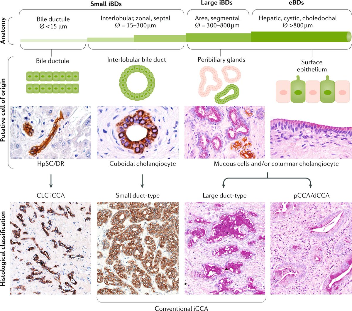 No.4 in our top10 articles that grabbed your attention (according to Altmetrics) - this CONSENSUS STATEMENT #Cholangiocarcinoma 2020: the next horizon in mechanisms and management #OPENACCESS go.nature.com/2YQ0XR7