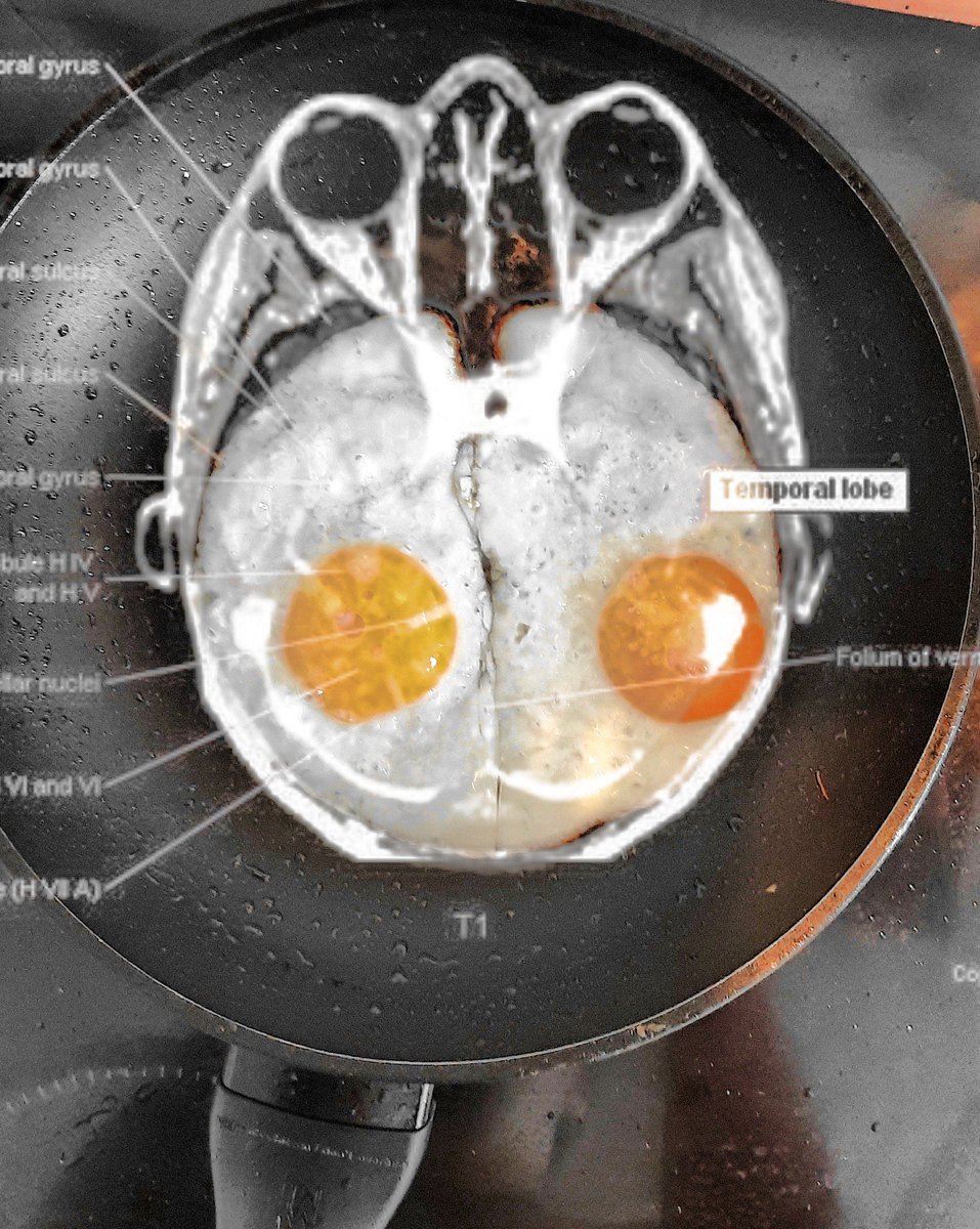 larapuhlmann's tweet photo. Unintentionally made a #BreakfastBrain 🍳 😅 Any psychoanalists here who can tell me what that says about my subconscious? https://t.co/wA3fDd6sL7