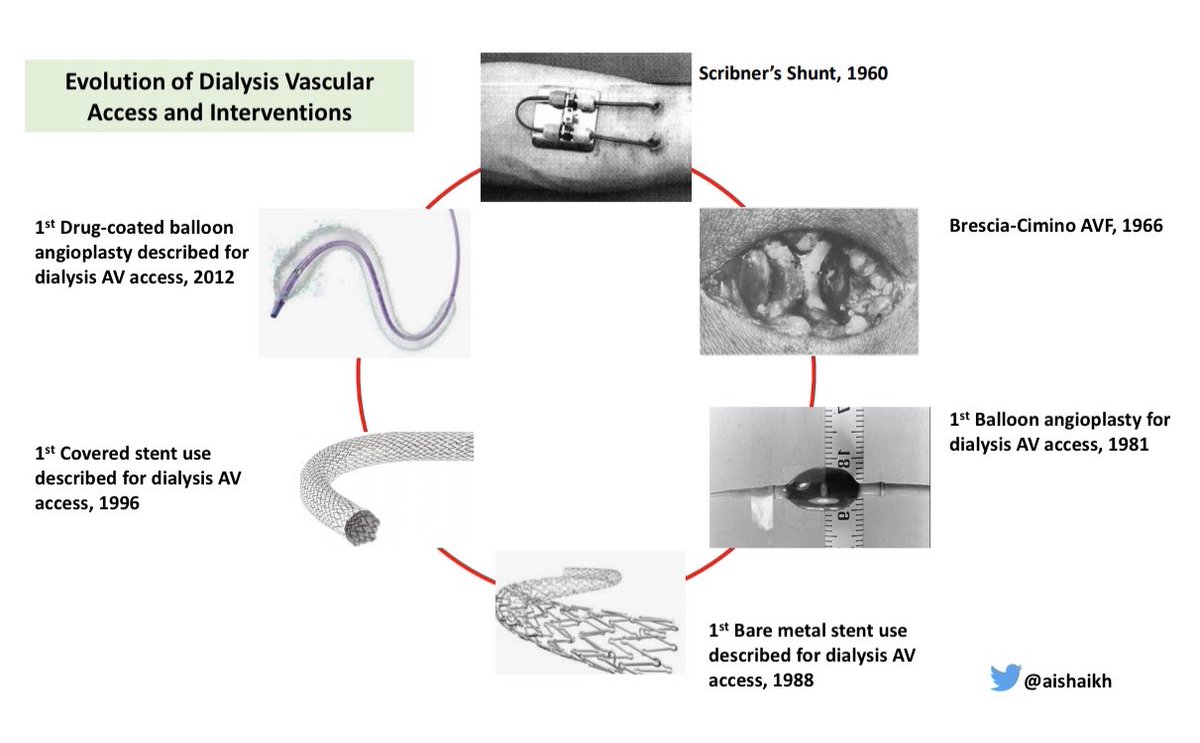 Vascular Access care has evolved over the past 60 years: -Scribner’s Shunt in 1960  -Brescia-Cimino AVF in 1966 -1st Balloon Angioplasty in 1981 -1st Bare Metal Stent in 1988 -1st Covered Stent in 1996 -DCB use in 2012 3/