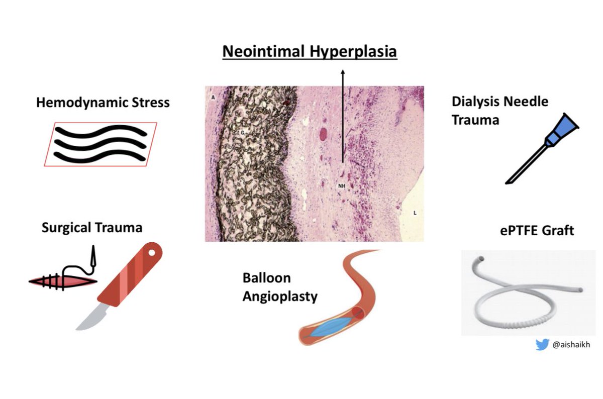 Neointimal Hyperplasia (NIH) causes vascular stenosis & it is due to: -Hemodynamic stress-Surgical trauma-Cannulation needle trauma-AVG But balloon angioplasty, the treatment for stenosis, can itself induce NIH & cause restenosis5/